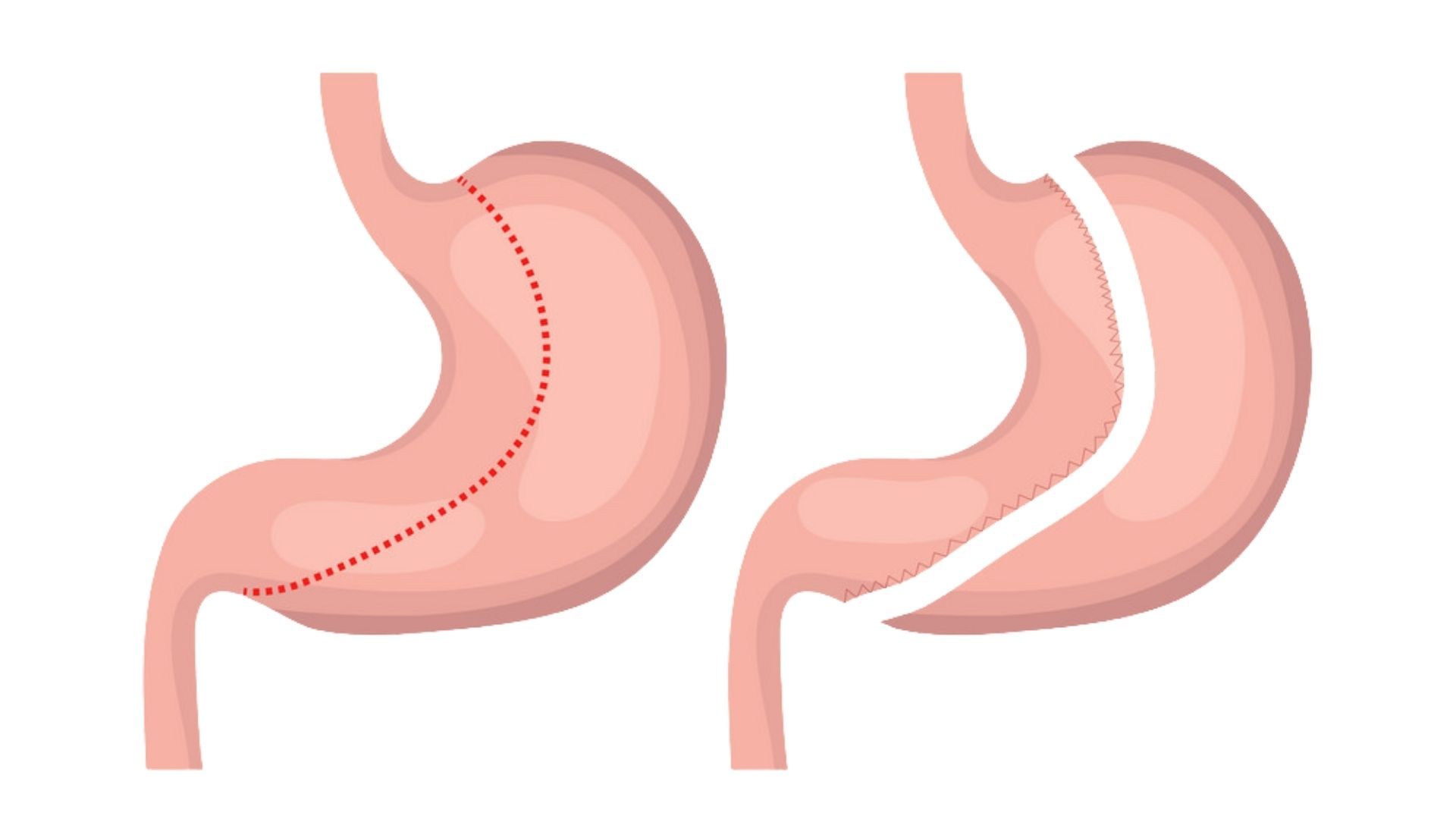 Your Comprehensive Guide to Gastric Sleeve Nutrition