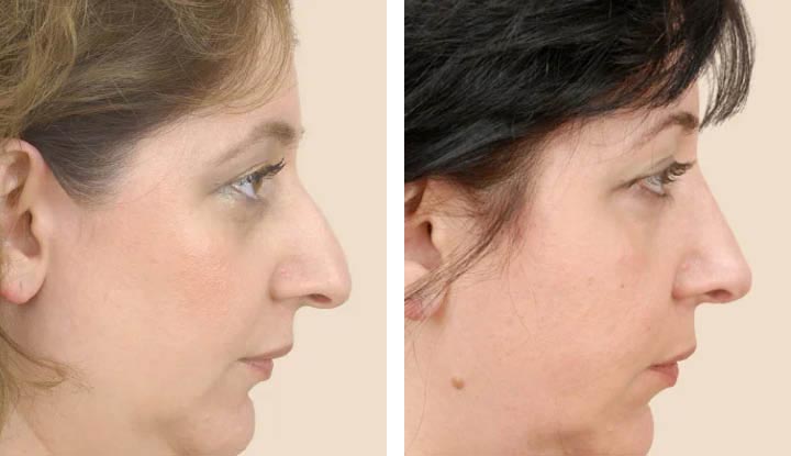 Nose Surgery: Transforming Faces and Lives